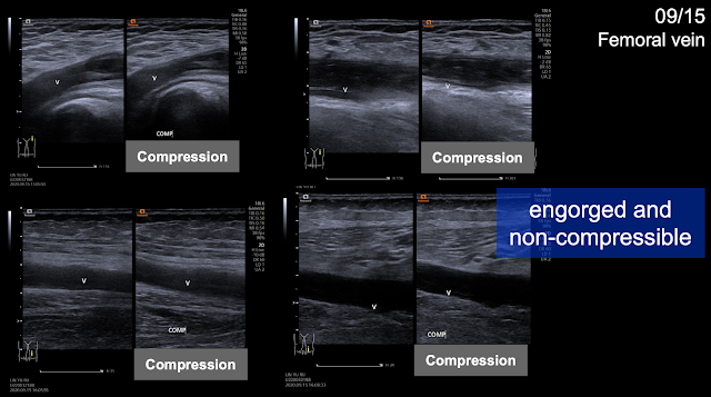 藏在腦出血背後的腦栓塞 - Survey of hypercoagubility, Cerebral venous thrombosis, and Protein S deficiency