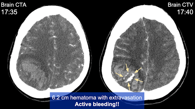 藏在腦出血背後的腦栓塞 - Survey of hypercoagubility, Cerebral venous thrombosis, and Protein S deficiency