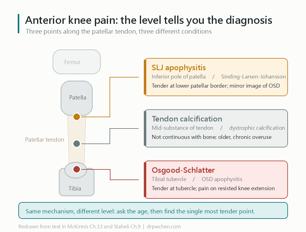 Differential diagnosis of three anterior knee pain locations: the inferior pole of the patella is SLJ apophysitis, the mid-substance of the tendon is patellar tendon calcification, and the tibial tubercle is Osgood-Schlatter apophysitis