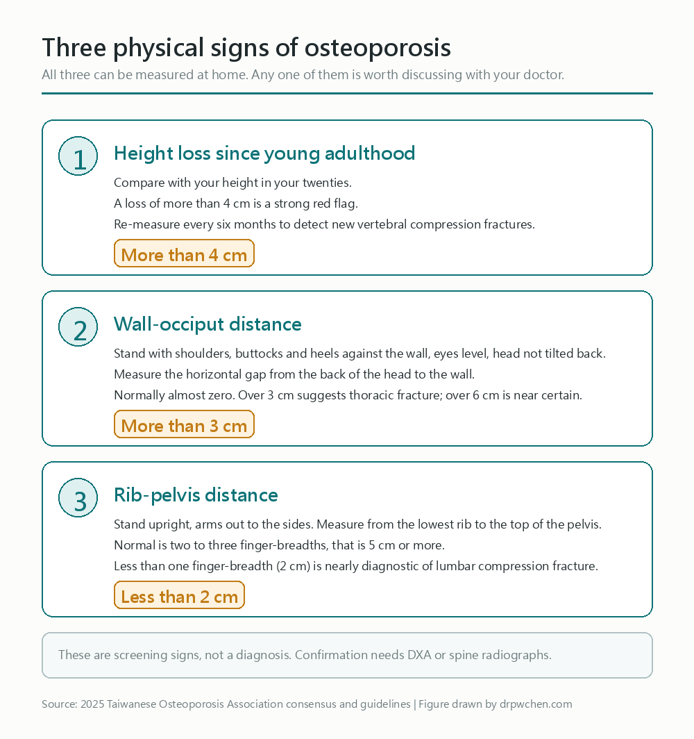Three physical signs of osteoporosis: over 4 cm shorter than in your youth, back of head over 3 cm from the wall when standing against it, and less than 2 cm from the lower ribs to the pelvis